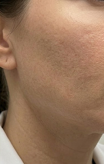 Acne scar treatment before and after comparison