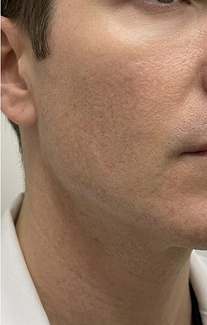 Male facial structure treatment before and after comparison