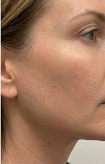 Facial redness treatment before and after comparison